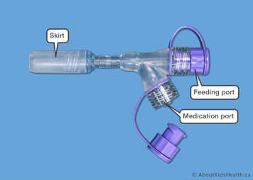 Medication port, cath tip syring port, skirt and feeding port on a Corlock Corport Y-adapter