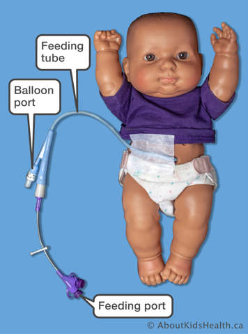 Foley catheter showing feeding tube, feeding port, balloon port and balloon