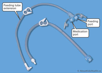Parts of an extension set detached from G tube