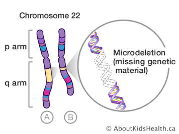 Chromosome 22 with missing genetic material