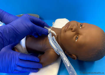 Child’s tracheostomy tube being removed