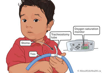 Illustration showing child who has pulled out their tracheostomy tube