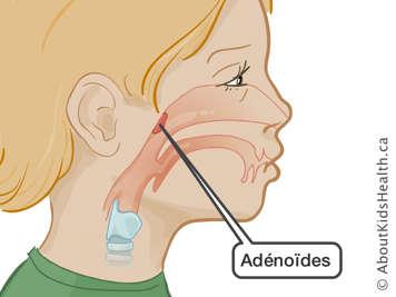 L'emplacement des adénoïdes
