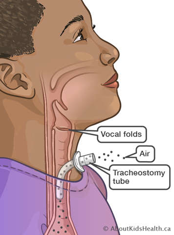 Illustration showing how air flows when there is a tracheostomy tube