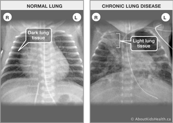 X-ray of normal lungs with dark lung tissue and X-ray of lungs affected by chronic lung disease with light lung tissue