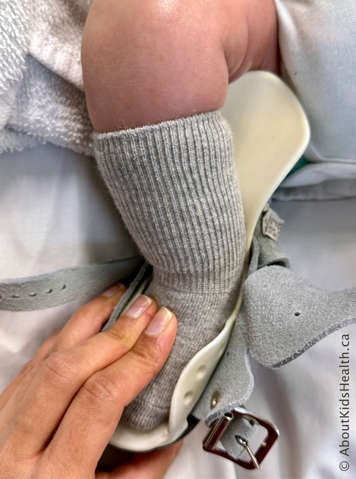 Child with clubfoot with caregiver holding the foot in the boot while making sure the heel is down