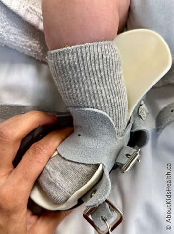 Child with clubfoot with caregiver pulling the tongue of the boot horizontally over the top of the foot