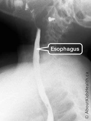 X-ray of esophagus