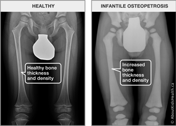 X-ray of thighs with healthy bone thickness and density and x-ray of thighs with increased bone thickness and density