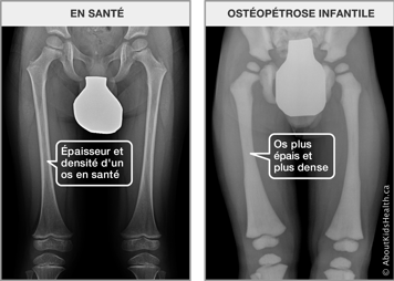 Images de rayon X des fémurs, l’un avec l’épaisseur et la densité d’un os en santé et l’autre avec l’os plus épais et dense