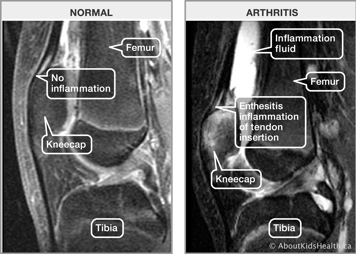 MRIs of normal knee joint and of arthritic knee joint with inflammation fluid and enthesitis inflammation of tendon insertion