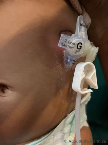 leakage around a g tube