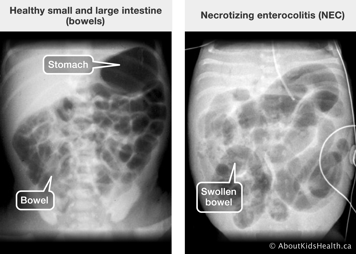 X-ray of healthy small and large intestines and x-ray of swollen bowel due to necrotizing enterocolitis