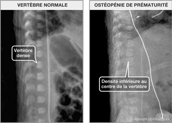 Rayon-x des vert&egrave;bres normaux et rayon-x des vert&egrave;bres d&rsquo;un patient atteint d&rsquo;ost&eacute;op&eacute;nie de la pr&eacute;mutarit&eacute;