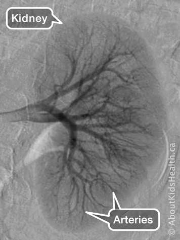 Identification of kidney and arteries in a kidney angiogram