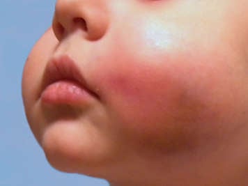 Infant with swollen cheeks