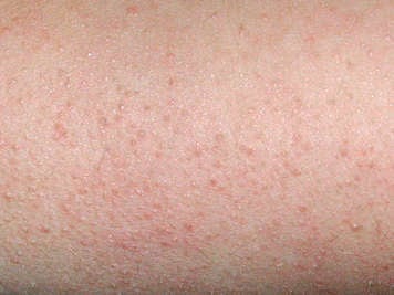 Skin affected by keratosis pilaris