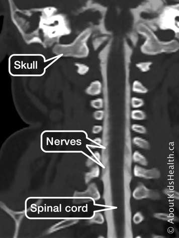 Identification of skull, spinal cord and nerves in CT scan myelogram