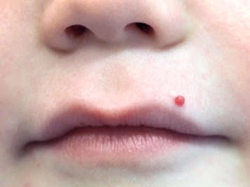 Child with a pyogenic granuloma on skin above the lip