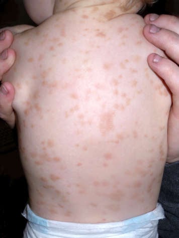 The back of a baby with urticaria pigmentosa