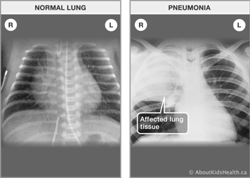 An X-ray of normal left and right lungs and an X-ray of lungs with pneumonia in the right side