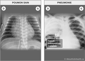 Une radiographie aux rayons X des poumons sains et une radiographie des poumons avec des tissus pulmonaires malades