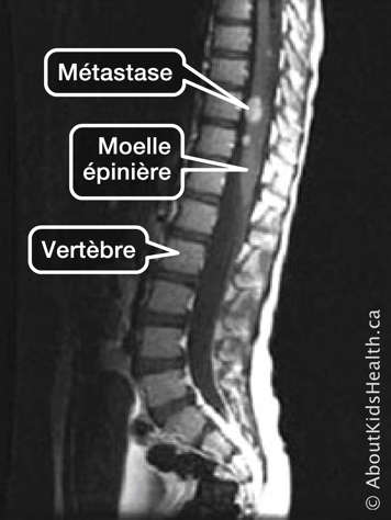 Un balayage montrant la vert&egrave;bre et la moelle &eacute;pini&egrave;re avec des m&eacute;tastases