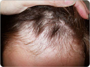 Le sommet de la tête d’un enfant avec perte de cheveux à l’avant de la tête