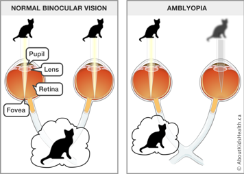 Amblyopia is demonstrated by a blurred image of a cat through the right eye and a clear image of a cat through the left eye
