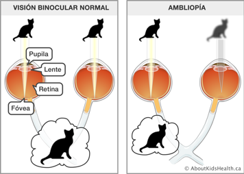 La ambliopía mostrada con una imagen borrosa de un gato por el ojo derecho y una imagen clara de un gato por el ojo izquierdo