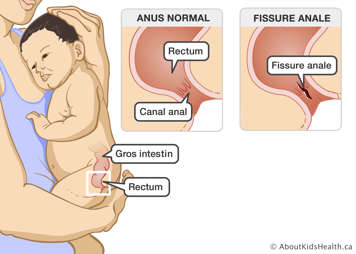 Le gros intestin et le rectum d'un bébé, anus normal avec le rectum et le canal anal identifiés, anus avec une déchirure