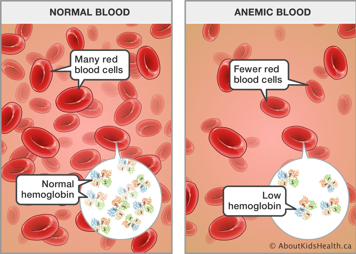 Normal blood with many red blood cells and normal hemoglobin, and anemic blood with fewer red blood cells and low hemoglobin