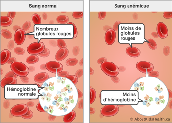 Sang avec nombreux globules rouges et hémoglobine normale et sang anémique avec moins de globules rouges et d’hémoglobine