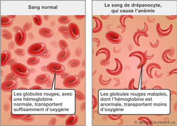 Globules rouges normaux transportent suffisamment d'oxygène lorsque les globules rouges malades transportent moins d'oxygène