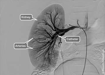 A kidney X-ray showing the arteries and catheter.