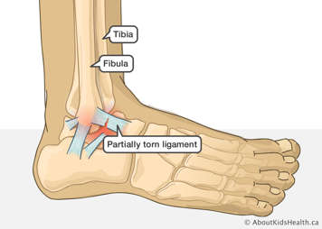 Tibia, fibula and partially torn ligament or ankle sprain