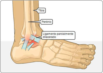 Tíbia, perónio e ligamento do tornozelo com rotura parcial