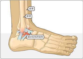 胫骨、腓骨以及踝关节处部分撕裂的韧带