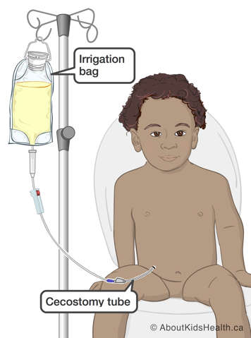 Child sitting on toilet with their cecostomy tube attached to an irrigation bag