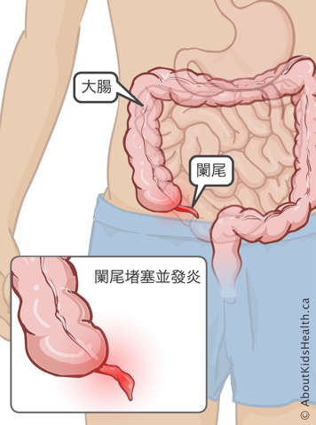 大腸和闌尾在人體內的位置，以及堵塞、發炎闌尾示意圖
