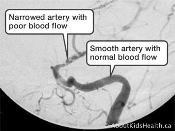 Cerebral angiogram showing a narrowed artery with poor blood flow and a smooth artery with normal blood flow