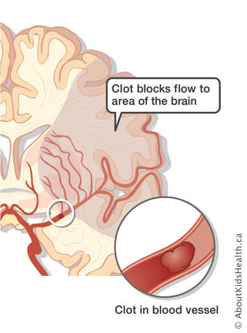 Clot in blood vessel and area of the brain affected