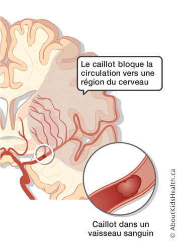 Un caillot dans un vaisseau sanguin et la région du cerveau touchée