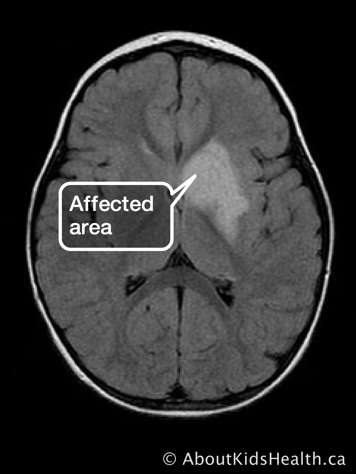 An MRI of the brain with affected area identified