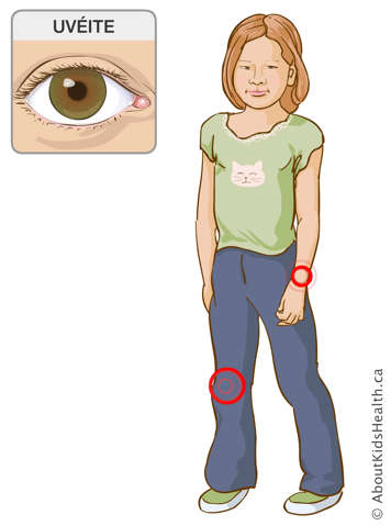 Identification des articulations des genoux et poignets d’une fille et une illustration d’un œil atteint de l’uvéite