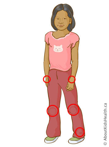 Identification of wrist, knee and ankle joints in a girl