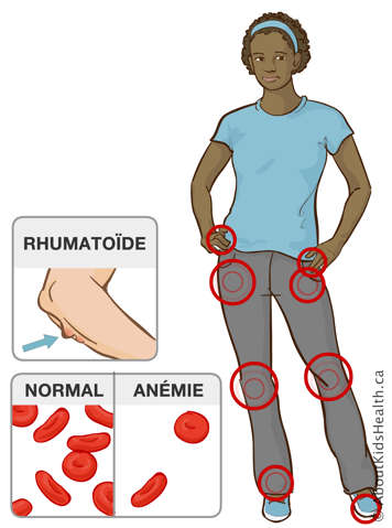 Les articulations des doigts, hanches, genoux, chevilles et orteils et une illustration des nodules rhumatoïdes sur le bras