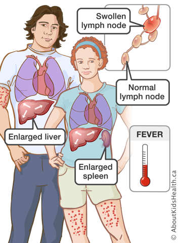Male with enlarged liver and a rash on the upper arms and female with enlarged spleen and a rash on the upper legs