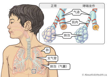 肺、气道和肺泡在人体中的位置分布，以及哮喘发作时气道、肌肉和肺泡的形态