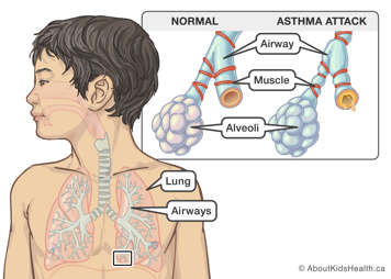 Normal airways, muscles and alveoli compared to those during an asthma attack